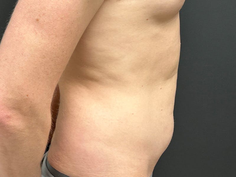 Abdomen Before & After Gallery - Patient 406127 - Image 5