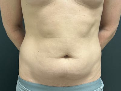 Mini Tummy Tuck Before & After Gallery - Patient 264633 - Image 1