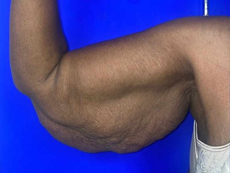 Arm Lift Before & After Gallery - Patient 122659 - Image 7