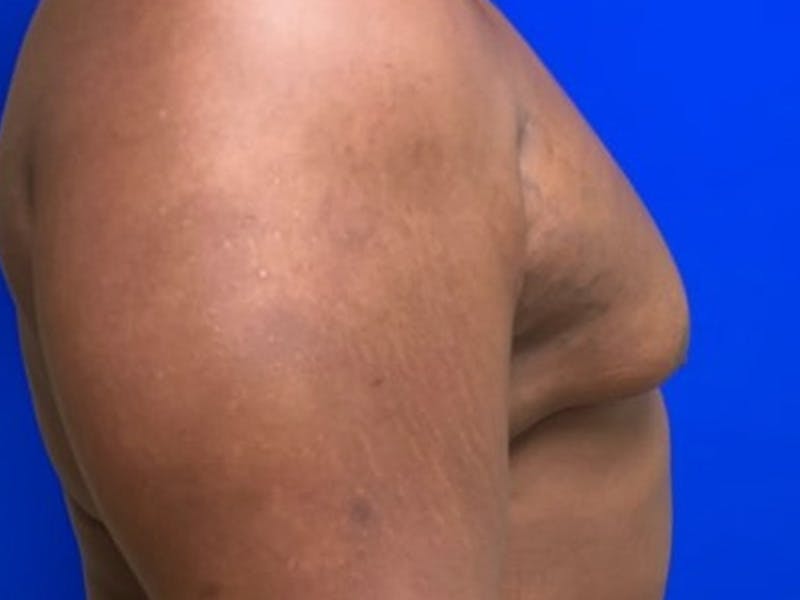Gynecomastia Before & After Gallery - Patient 150764 - Image 5