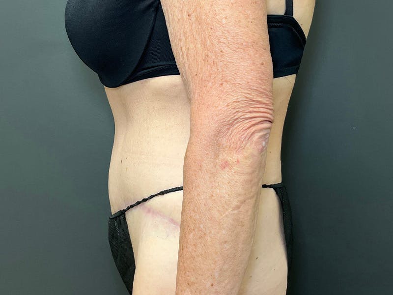 Tummy Tuck Before & After Gallery - Patient 394420 - Image 10