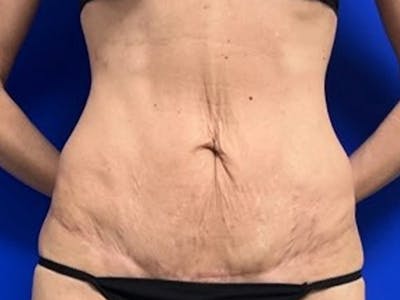 Mini Tummy Tuck Before & After Gallery - Patient 309547 - Image 2