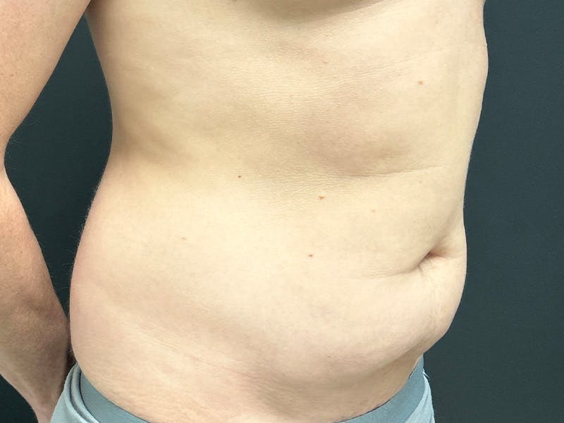 Mini Tummy Tuck Before & After Gallery - Patient 264633 - Image 3