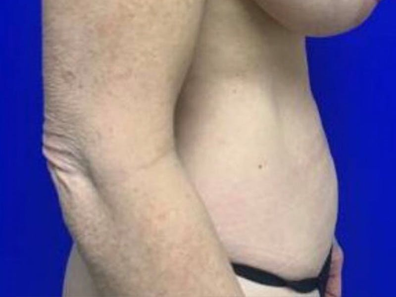 Mini Tummy Tuck Before & After Gallery - Patient 491163 - Image 6