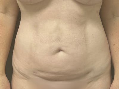 Abdomen Before & After Gallery - Patient 332408 - Image 2