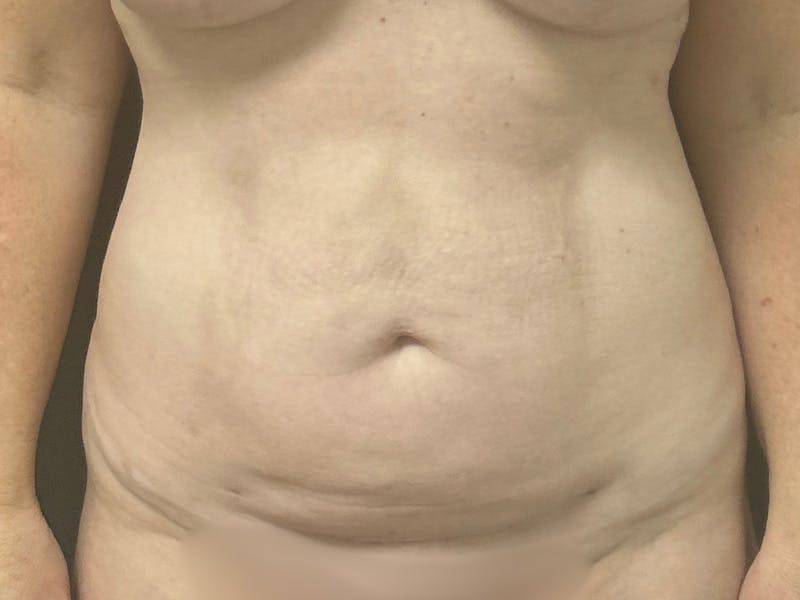 Abdomen Before & After Gallery - Patient 332408 - Image 2