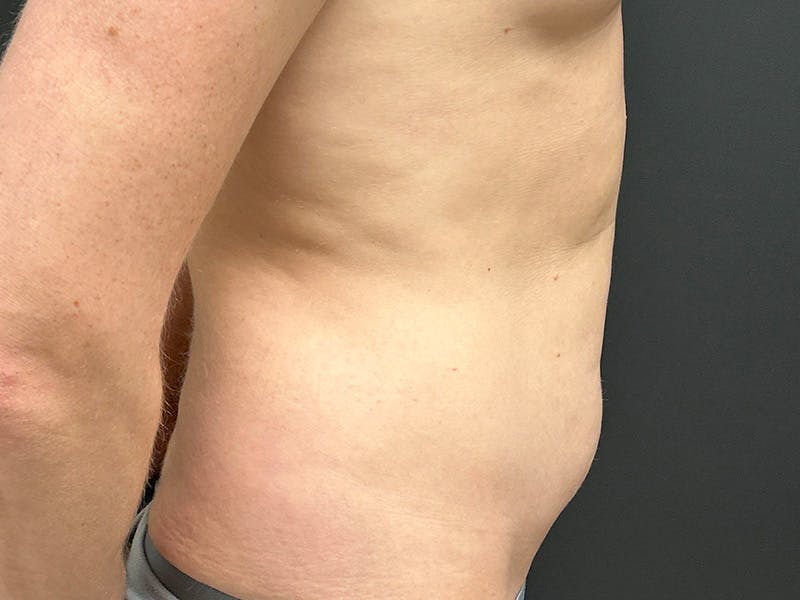 Mini Tummy Tuck Before & After Gallery - Patient 264633 - Image 5