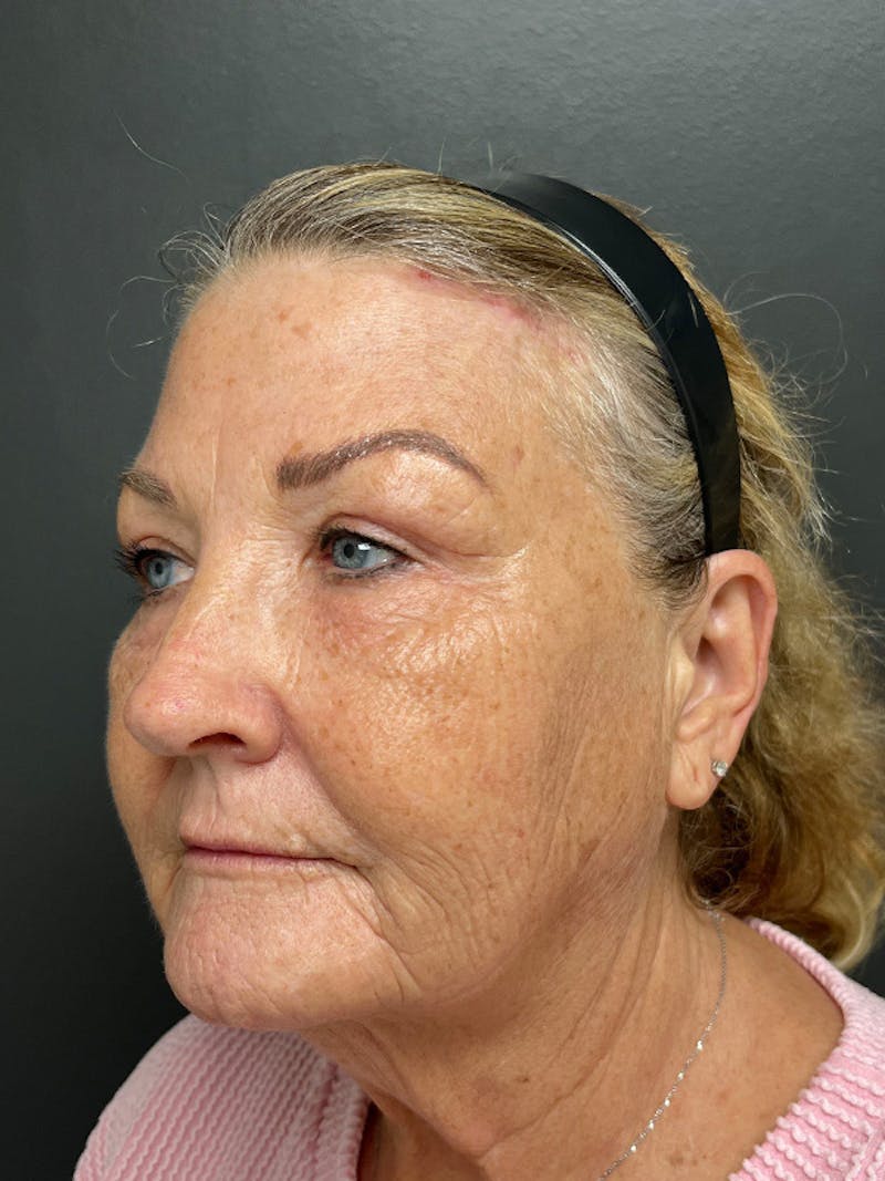 Brow Lift Before & After Gallery - Patient 206709 - Image 8