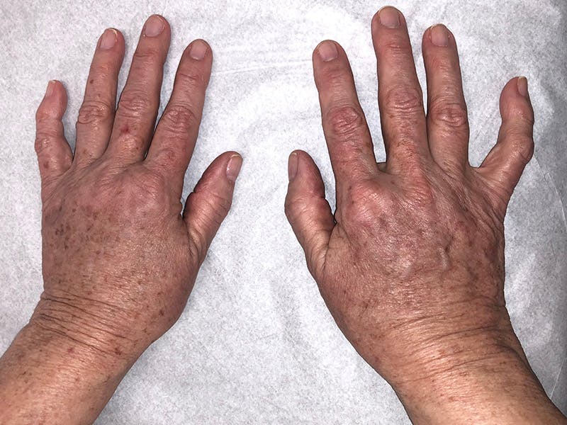 Hand Fat Grafting Before & After Gallery - Patient 195401 - Image 2