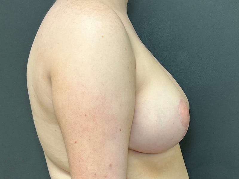 Breast Augmentation with Lift Before & After Gallery - Patient 132296 - Image 6