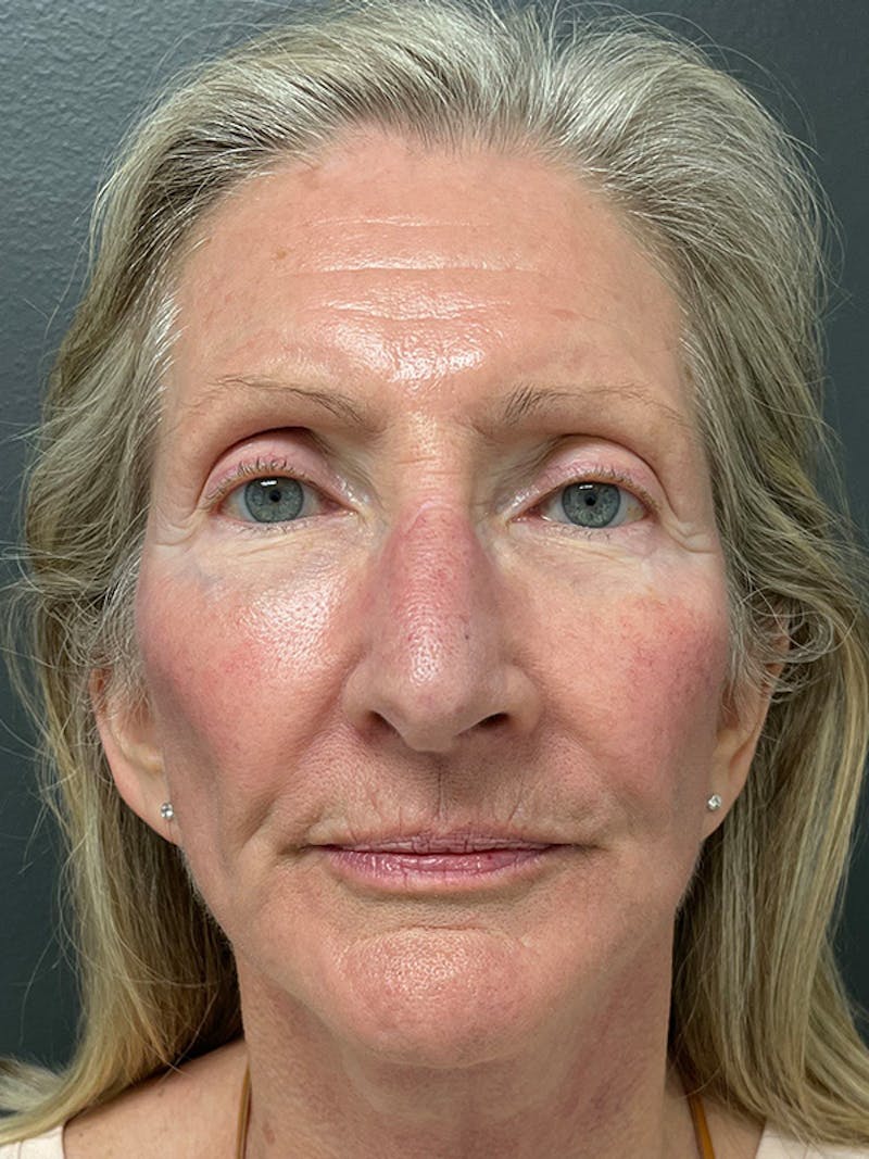 Earlobe Repair Before & After Gallery - Patient 298992 - Image 6