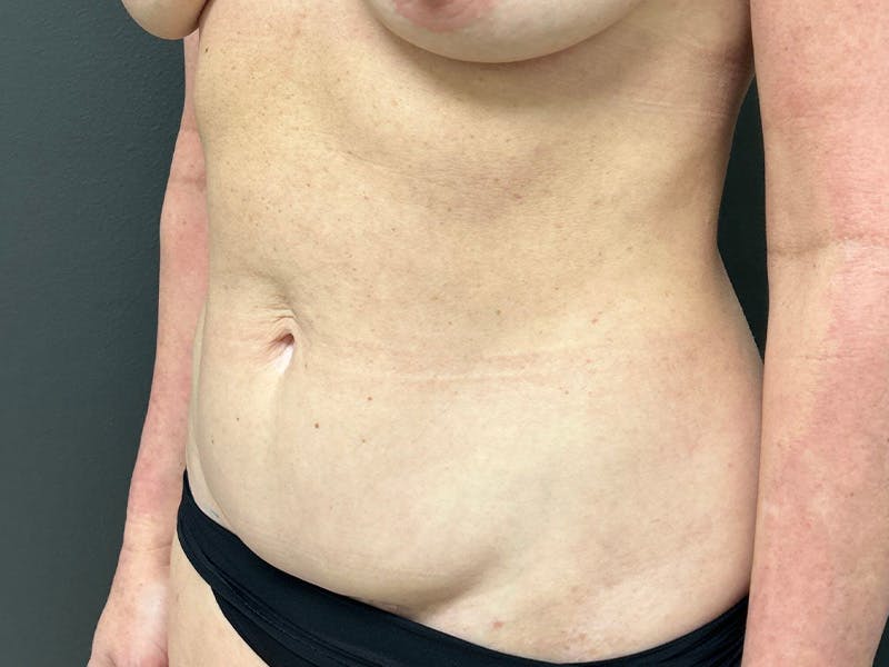 Abdomen Before & After Gallery - Patient 357328 - Image 7