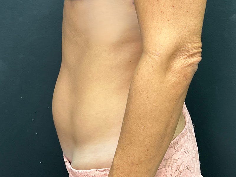 Mini Tummy Tuck Before & After Gallery - Patient 246074 - Image 9