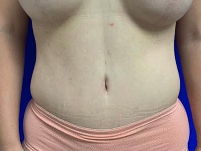 Tummy Tuck Before & After Gallery - Patient 308747 - Image 2