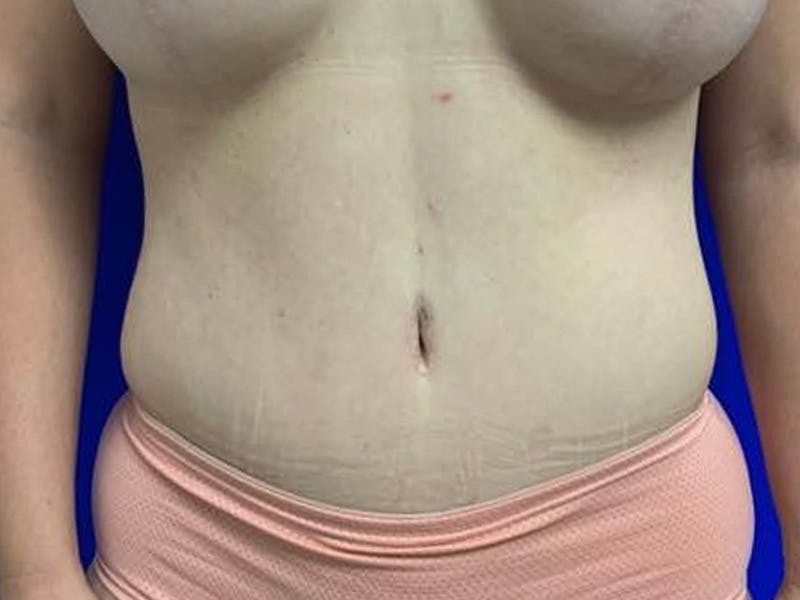 Tummy Tuck Before & After Gallery - Patient 308747 - Image 2