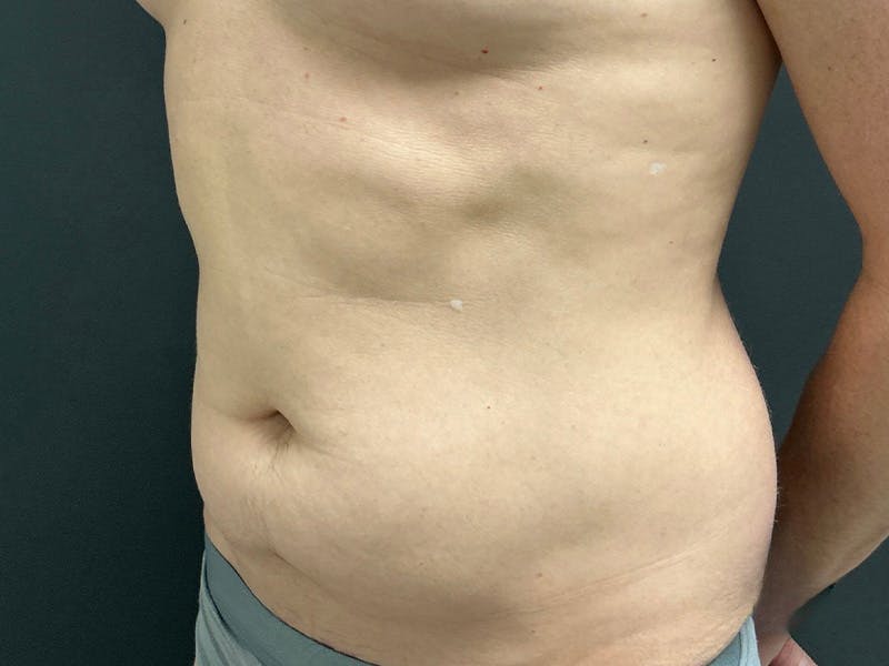 Mini Tummy Tuck Before & After Gallery - Patient 264633 - Image 7