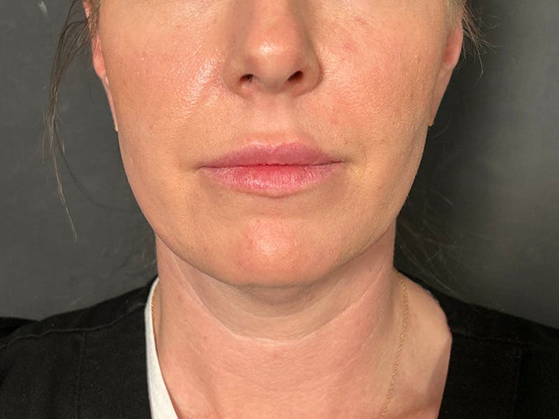 Submental Before & After Gallery - Patient 281129 - Image 5