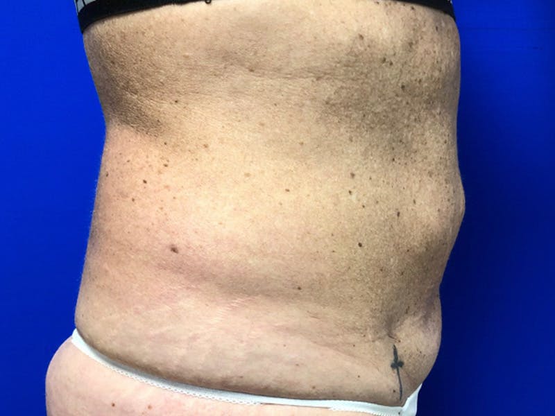 Tummy Tuck Before & After Gallery - Patient 334681 - Image 3