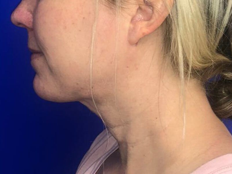 Submental Before & After Gallery - Patient 238853 - Image 6