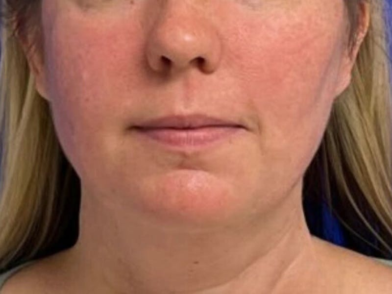 Submental Before & After Gallery - Patient 238853 - Image 3
