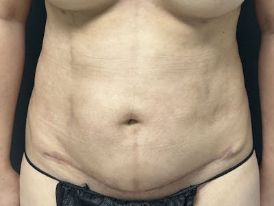 Mini Tummy Tuck Before & After Gallery - Patient 263277 - Image 2