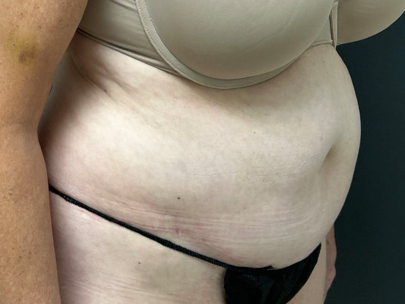 Abdomen Before & After Gallery - Patient 784997 - Image 3