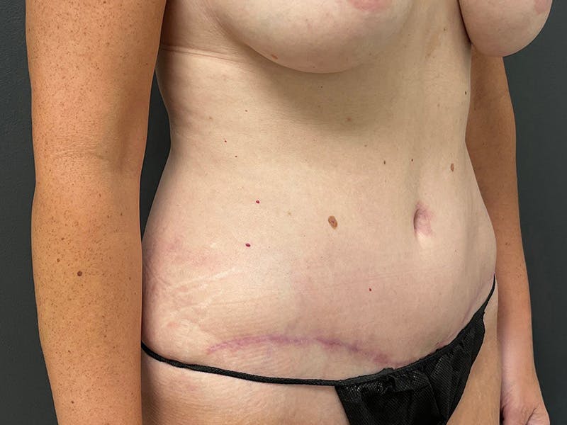 Tummy Tuck Before & After Gallery - Patient 328270 - Image 4