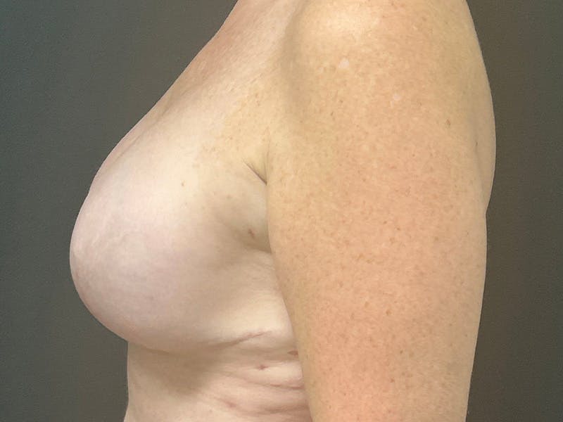 Breast Implant Reconstruction Before & After Gallery - Patient 121284 - Image 10