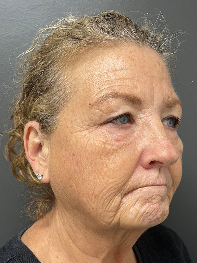 Brow Lift Before & After Gallery - Patient 206709 - Image 5