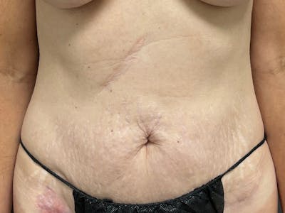 Mini Tummy Tuck Before & After Gallery - Patient 284453 - Image 2