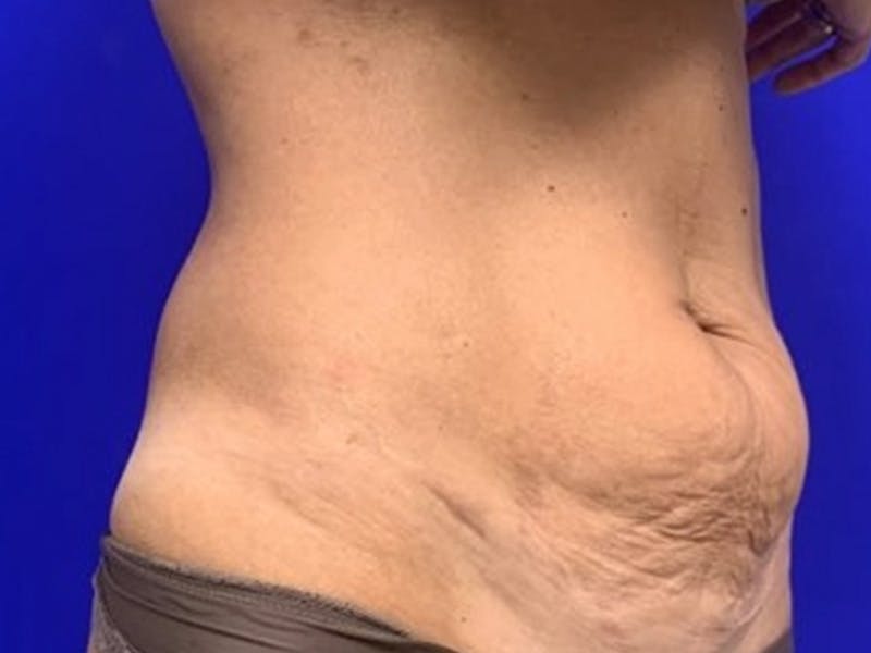Mini Tummy Tuck Before & After Gallery - Patient 309547 - Image 3