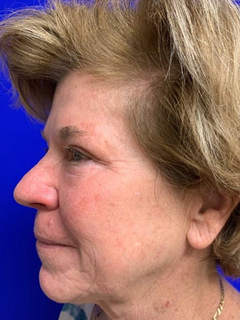Brow Lift Before & After Gallery - Patient 256609 - Image 6