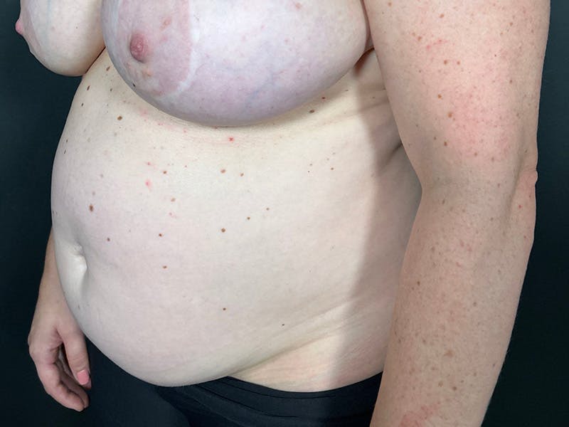 Mini Tummy Tuck Before & After Gallery - Patient 169656 - Image 7
