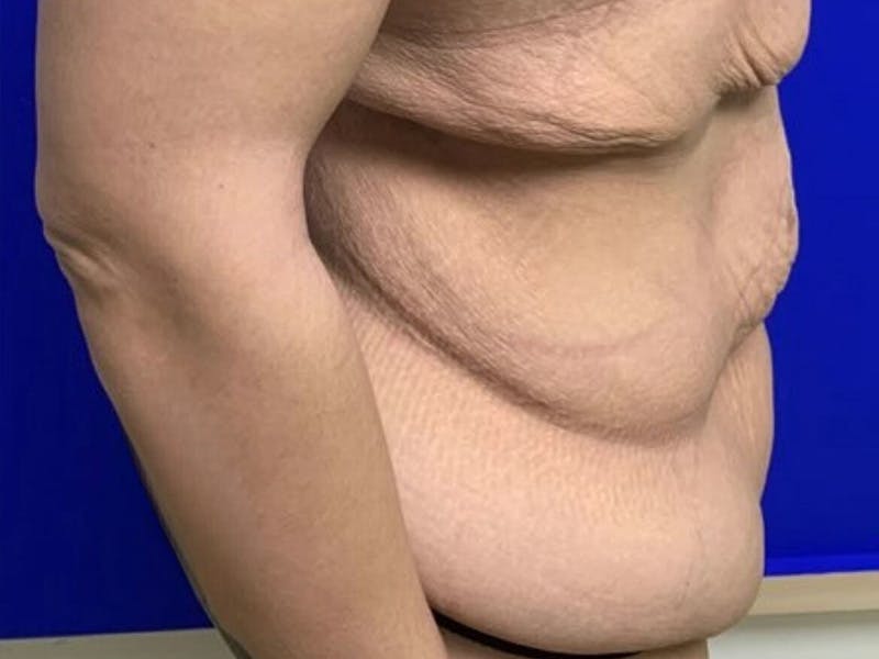 Tummy Tuck Before & After Gallery - Patient 102921 - Image 3