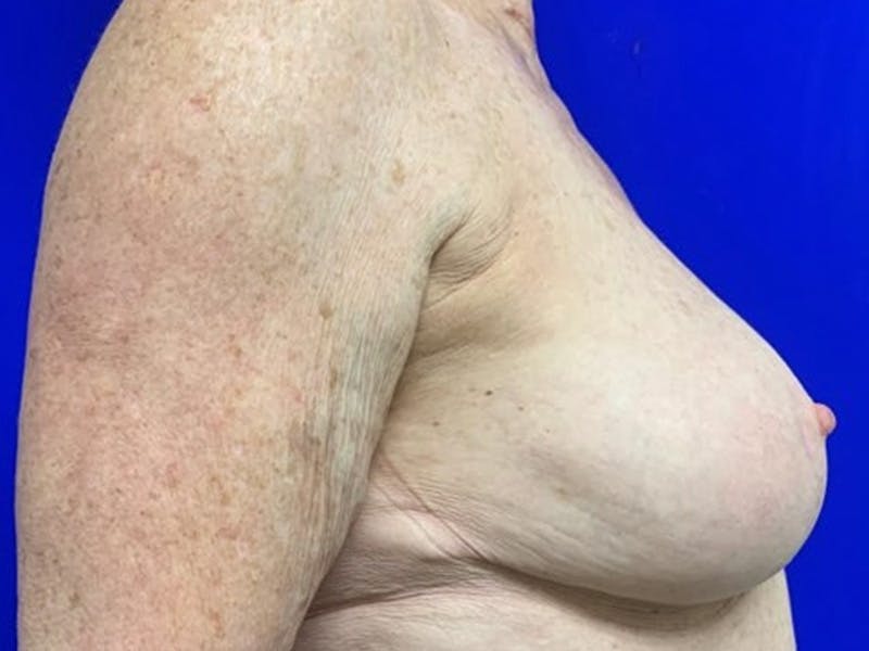 Breast Reconstruction Before & After Gallery - Patient 265807 - Image 6
