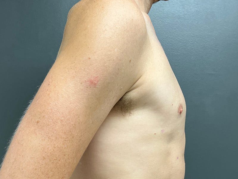 Gynecomastia Before & After Gallery - Patient 376405 - Image 6