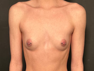 Breast Augmentation Before & After Gallery - Patient 251186 - Image 1