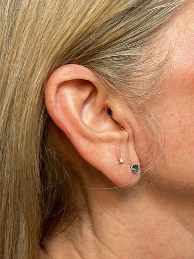 Earlobe Repair Before & After Gallery - Patient 298992 - Image 1
