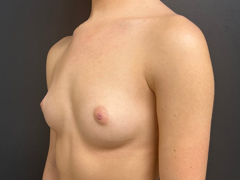 Breast Augmentation Before & After Gallery - Patient 429014 - Image 7