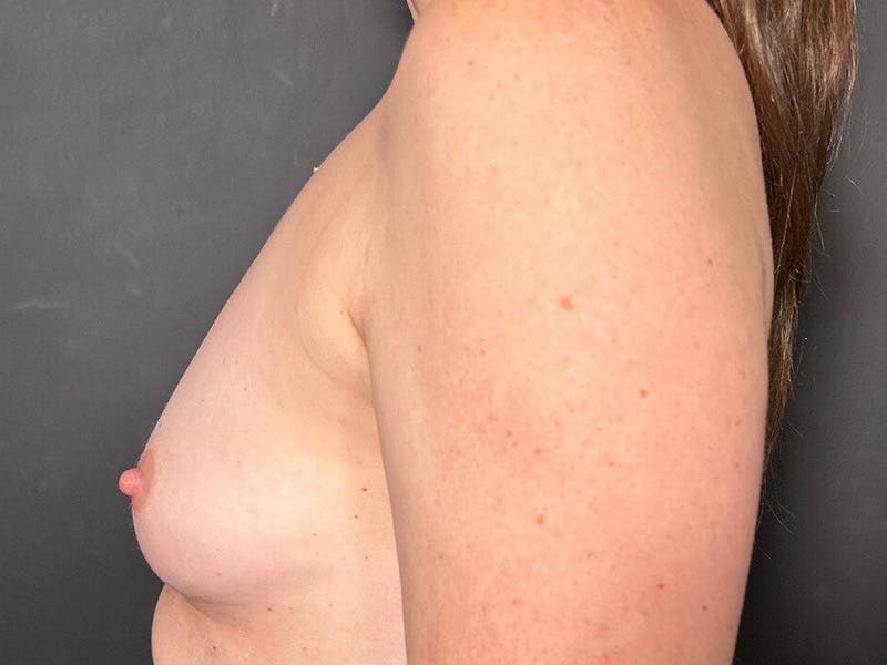 Breast Fat Grafting Before & After Gallery - Patient 902109 - Image 9