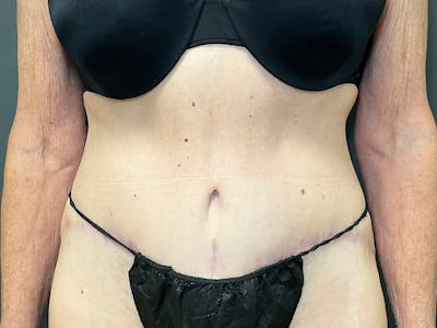 Tummy Tuck Before & After Gallery - Patient 394420 - Image 2