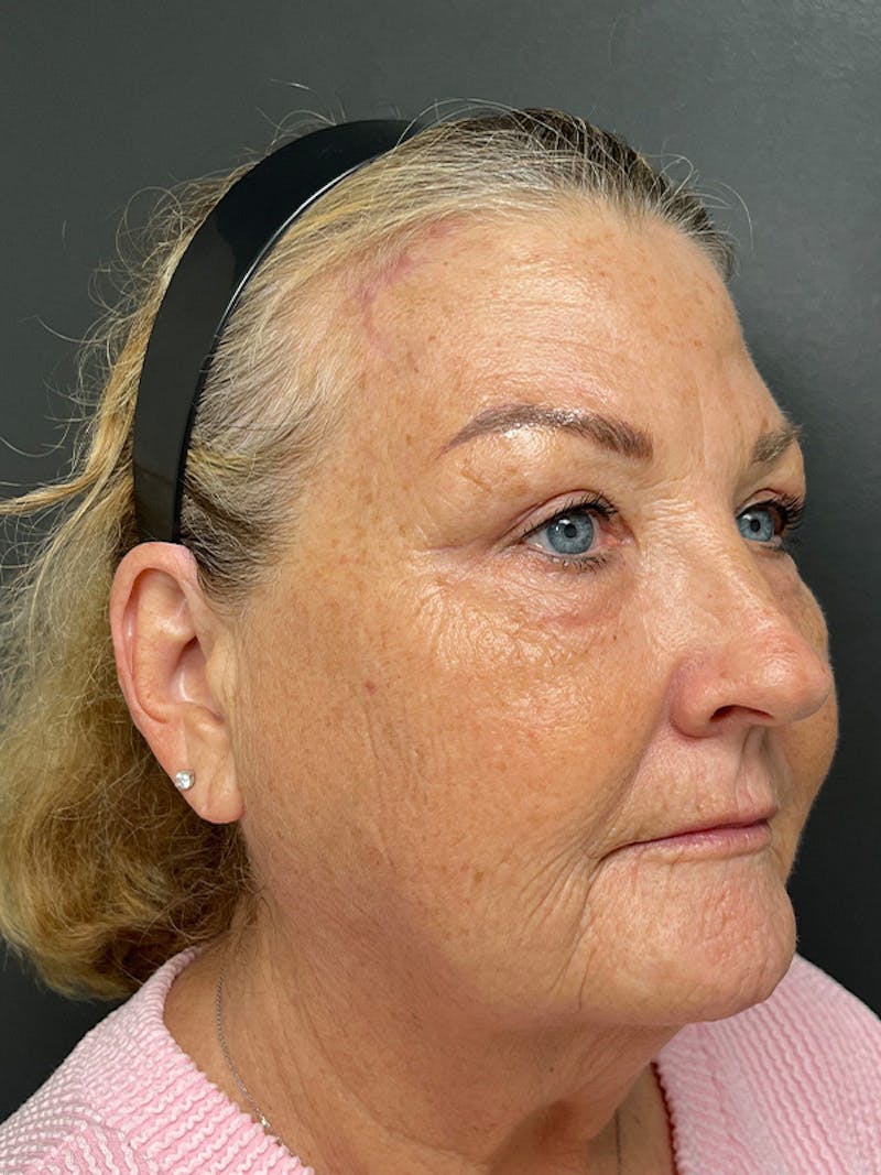 Brow Lift Before & After Gallery - Patient 206709 - Image 6