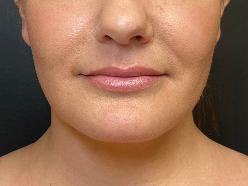 Submental Before & After Gallery - Patient 252708 - Image 6
