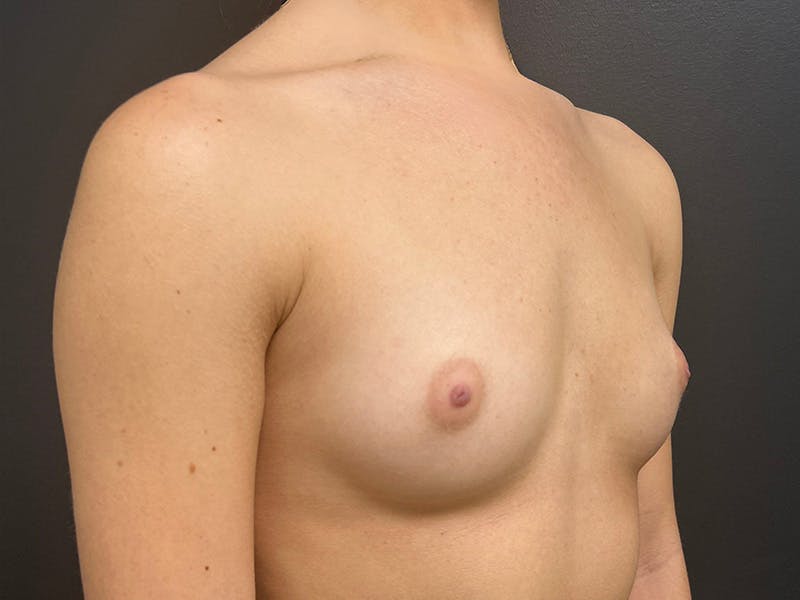 Breast Augmentation Before & After Gallery - Patient 429014 - Image 3