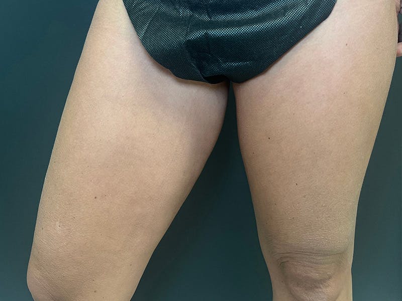 Thigh Lift Before & After Gallery - Patient 105155 - Image 5