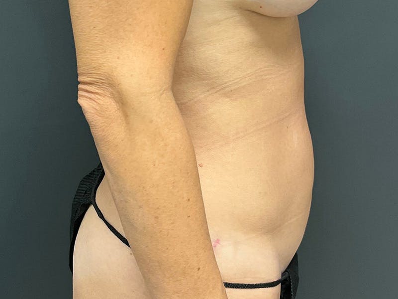 Mini Tummy Tuck Before & After Gallery - Patient 246074 - Image 6