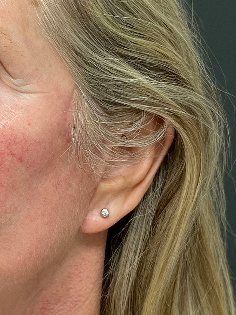 Earlobe Repair Before & After Gallery - Patient 298992 - Image 8