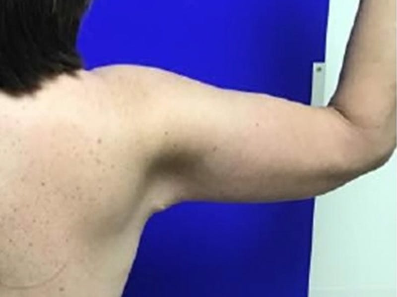 Arm Lift Before & After Gallery - Patient 256451 - Image 4