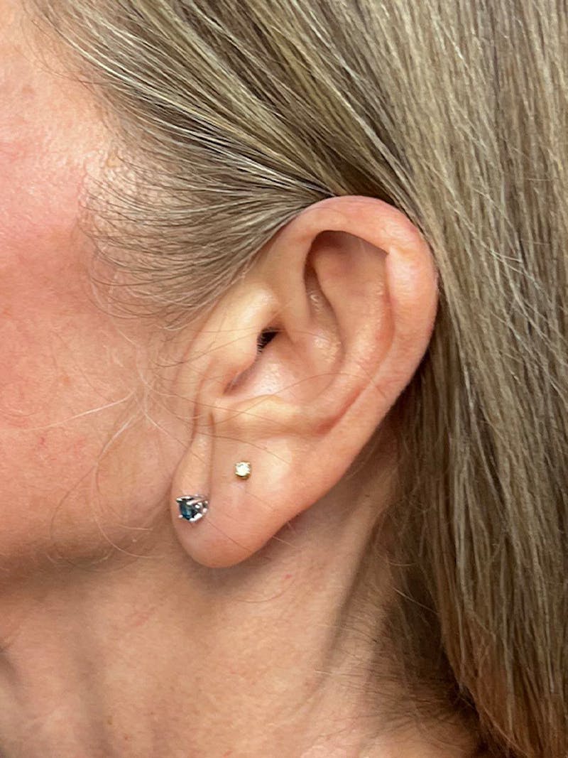 Earlobe Repair Before & After Gallery - Patient 298992 - Image 9
