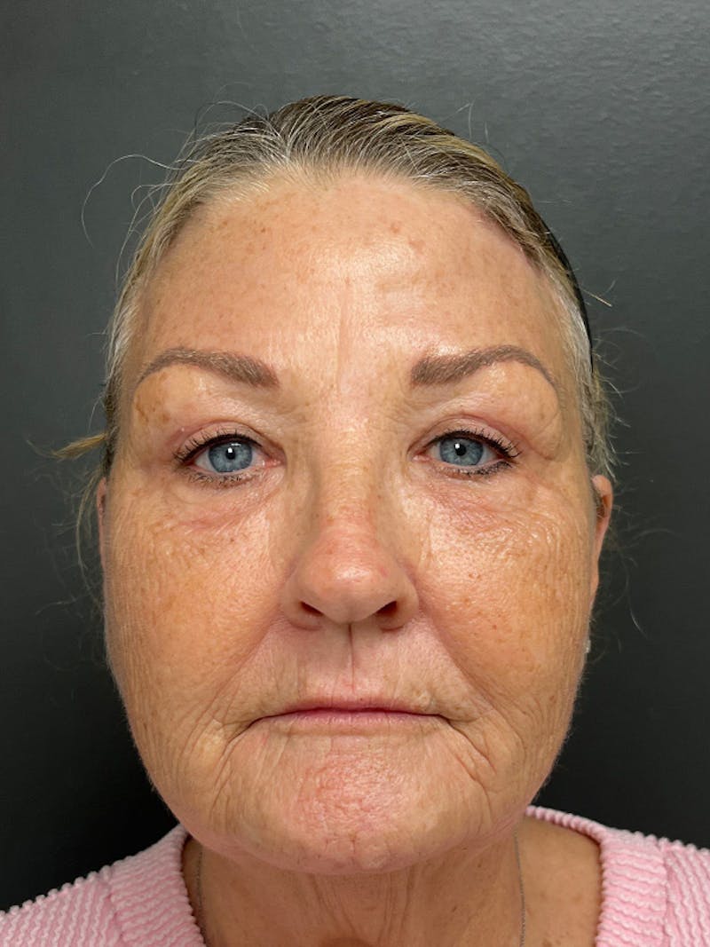 Brow Lift Before & After Gallery - Patient 206709 - Image 4